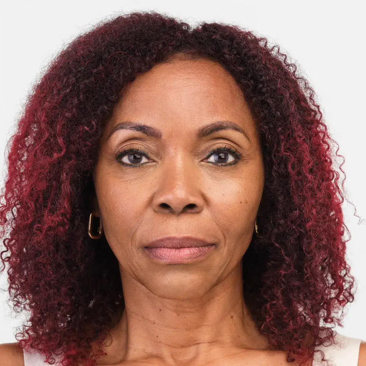 Womans face after Radiesse treatment
