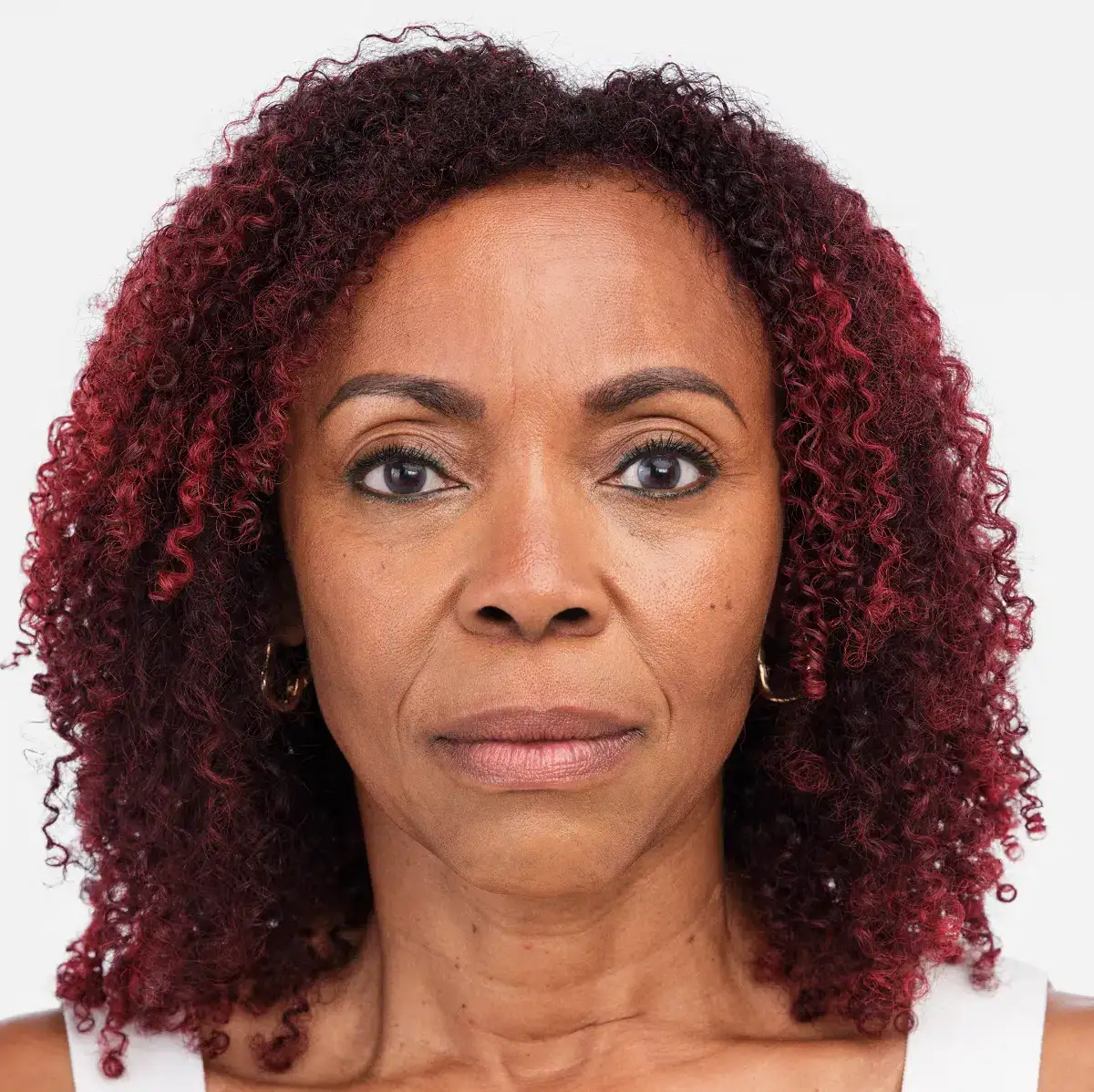 Womans face before Radiesse treatment