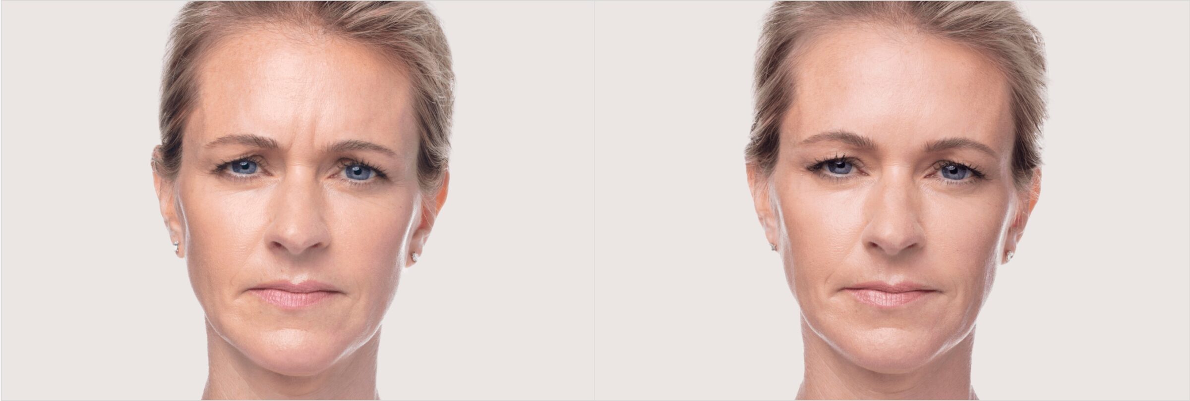 Before & after results of dysport on face