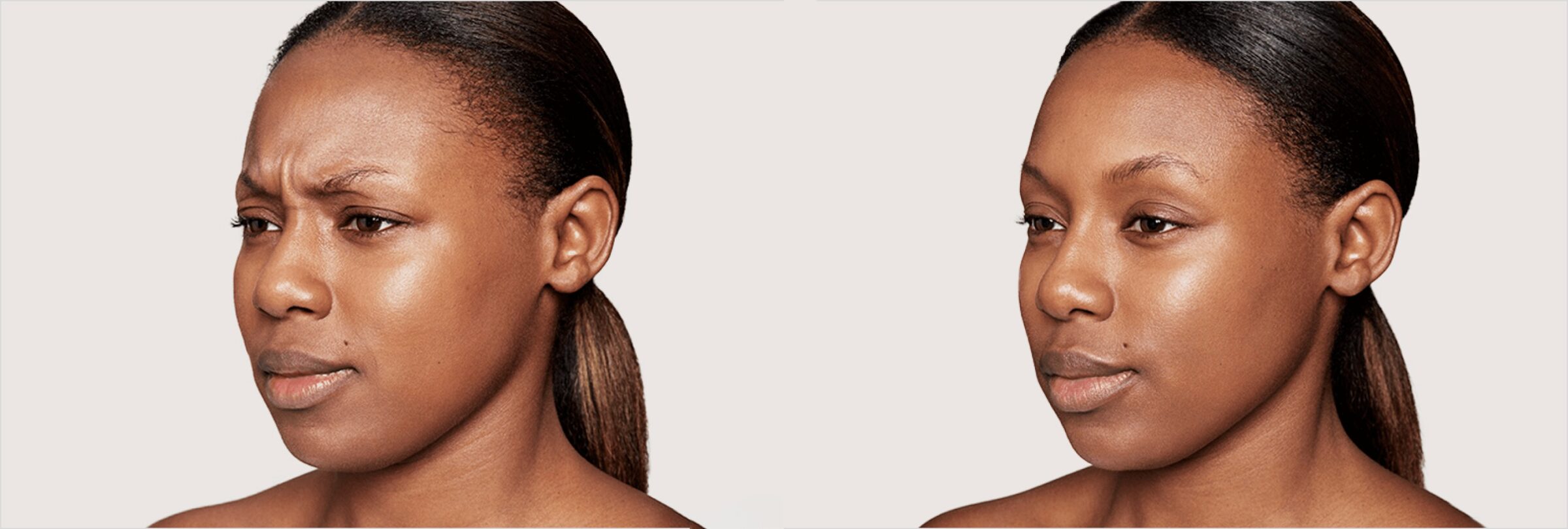 Before & after results of dysport on face