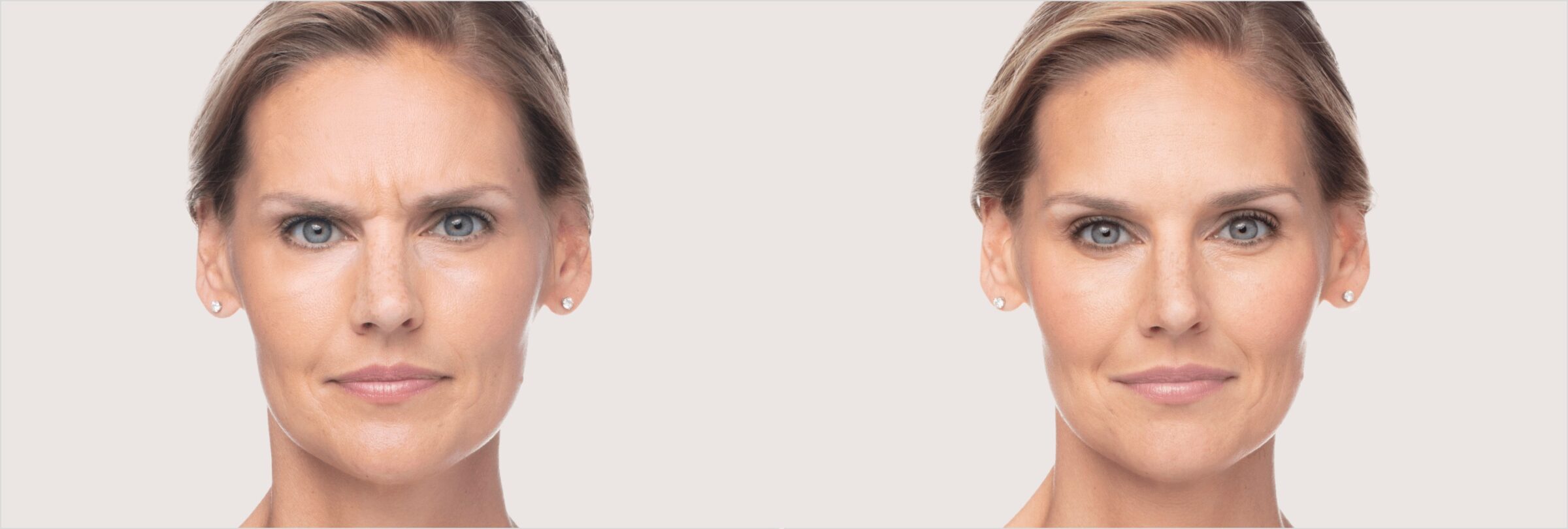 Before & after results of dysport on face