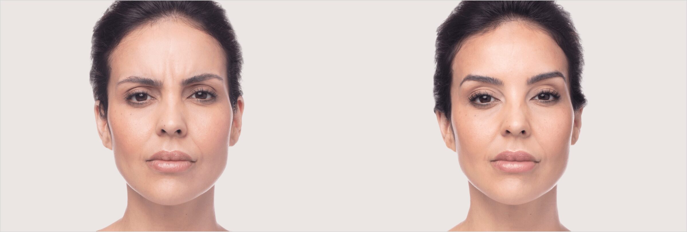 Before & after results of dysport on face