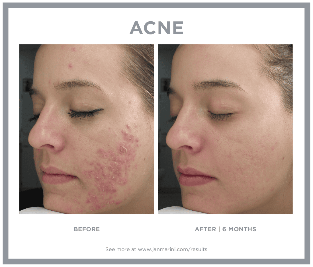 Jan Marini B&A 2