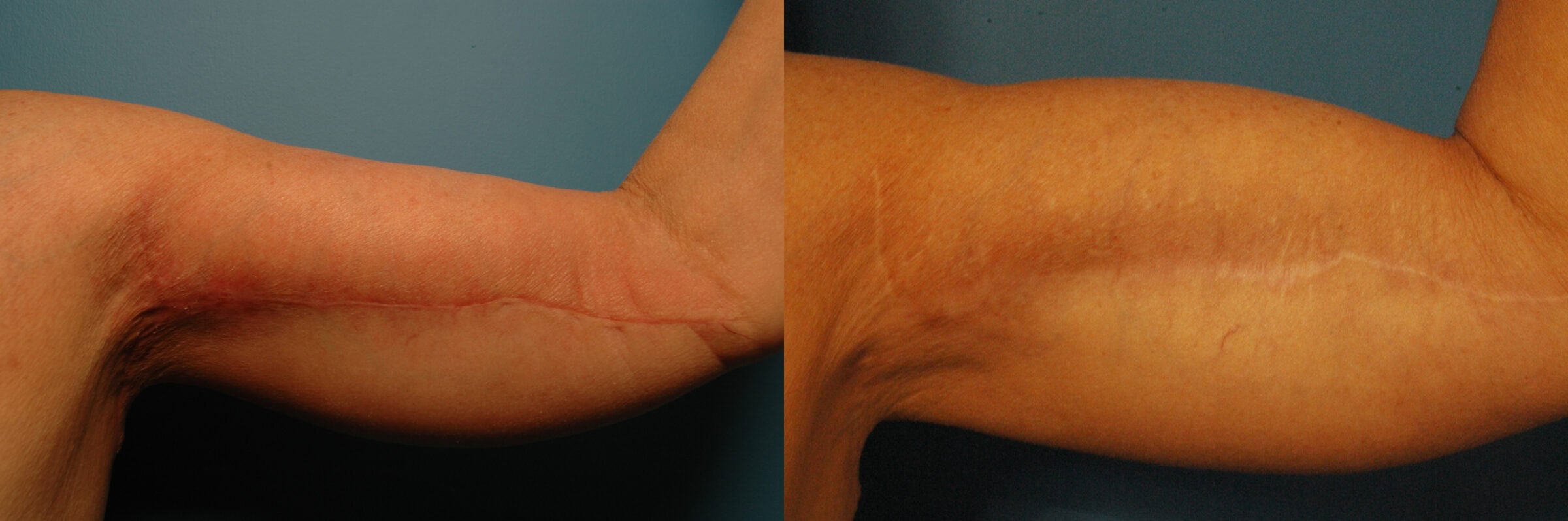 arm lift results post surgery