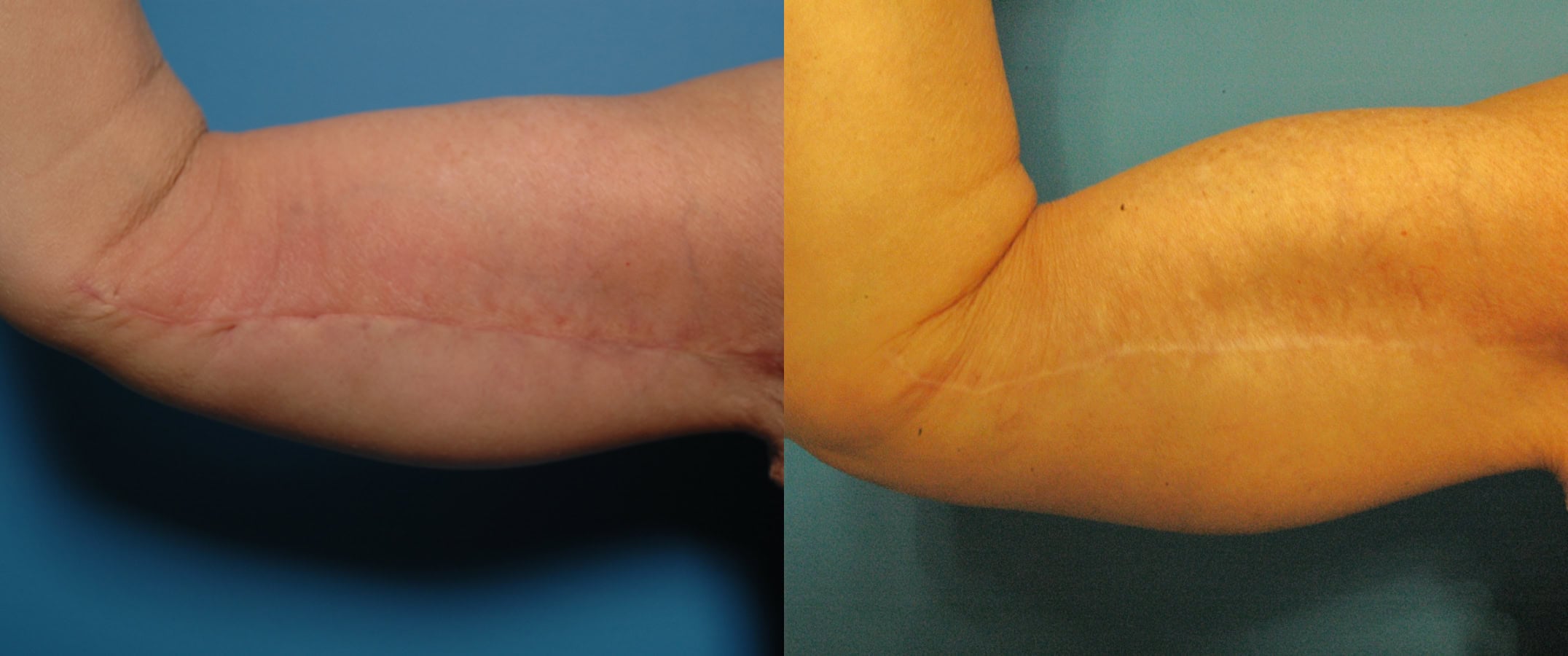 arm lift results post surgery