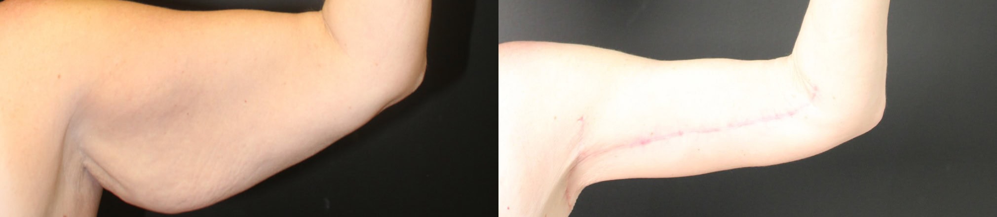 before arm lift and post surgery results