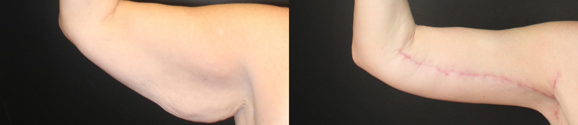 before arm lift and post surgery results