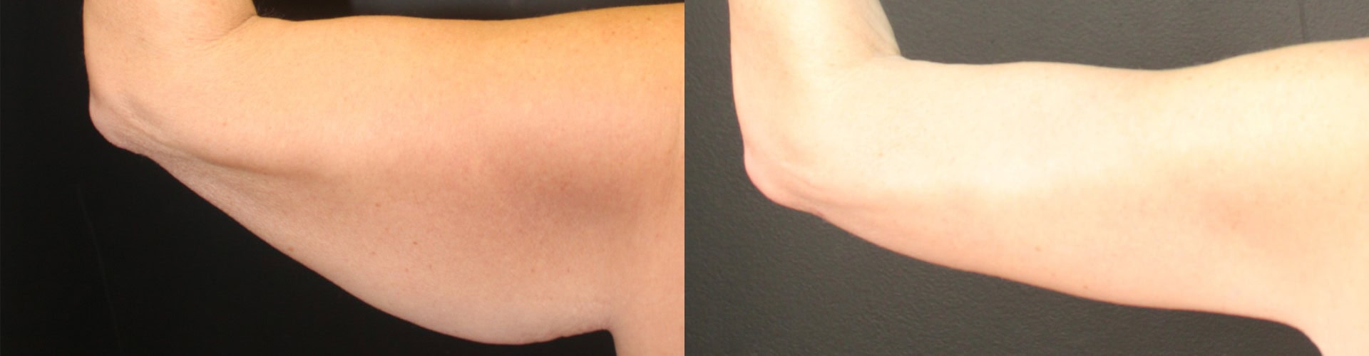 before arm lift and post surgery results