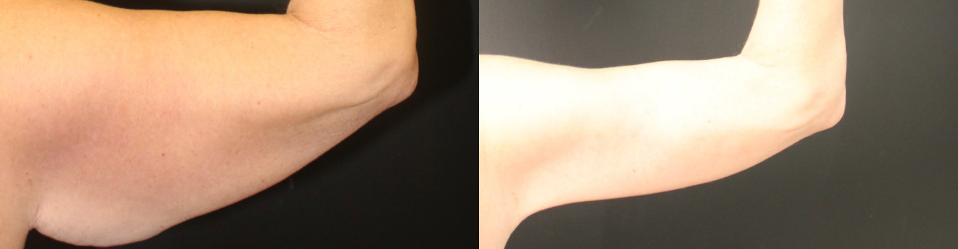 before arm lift and post surgery results