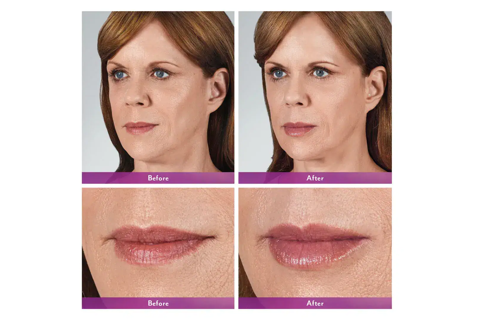 Womans's face before and after Juvederm treatment