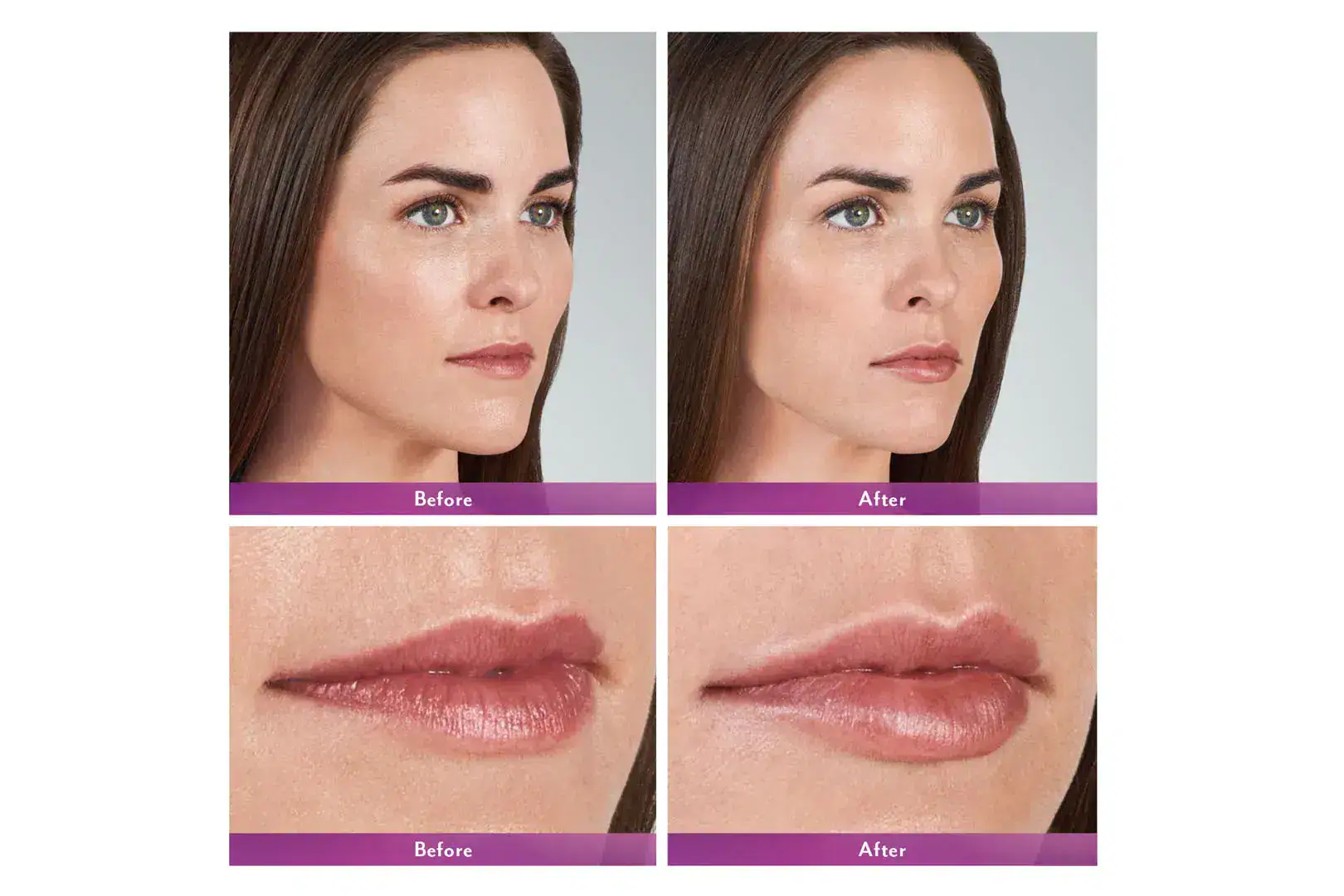 Womans's face before and after Juvederm treatment