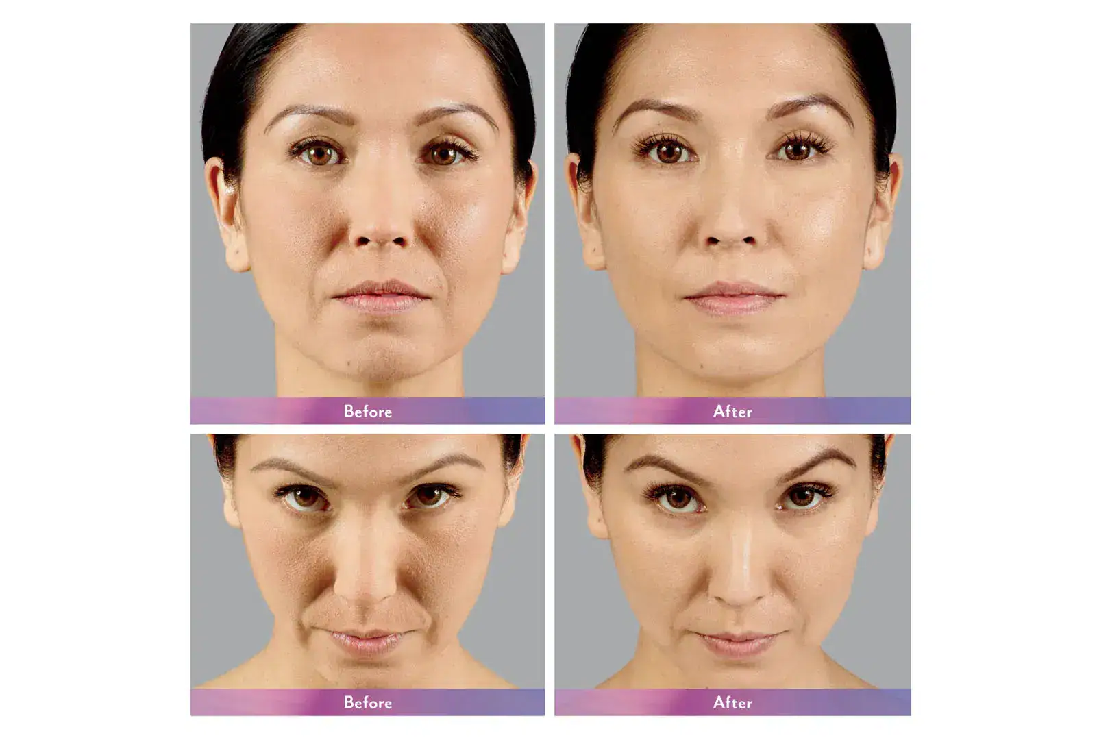 Womans's face before and after Juvederm treatment