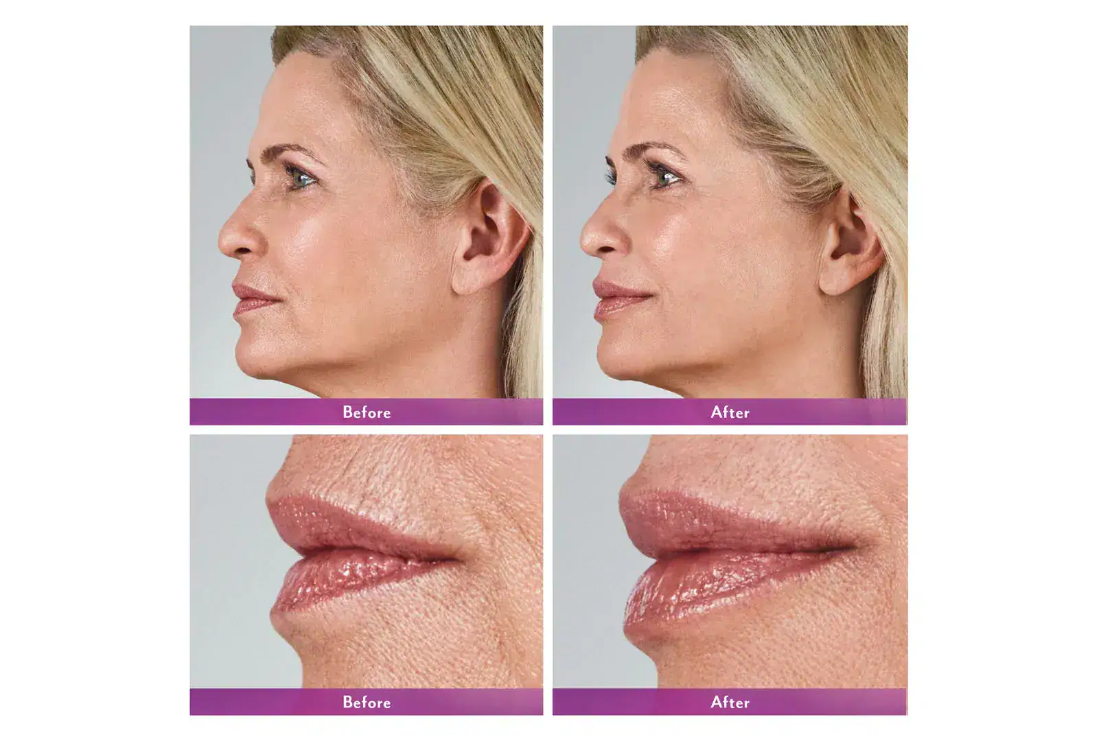 Womans's face before and after Juvederm treatment