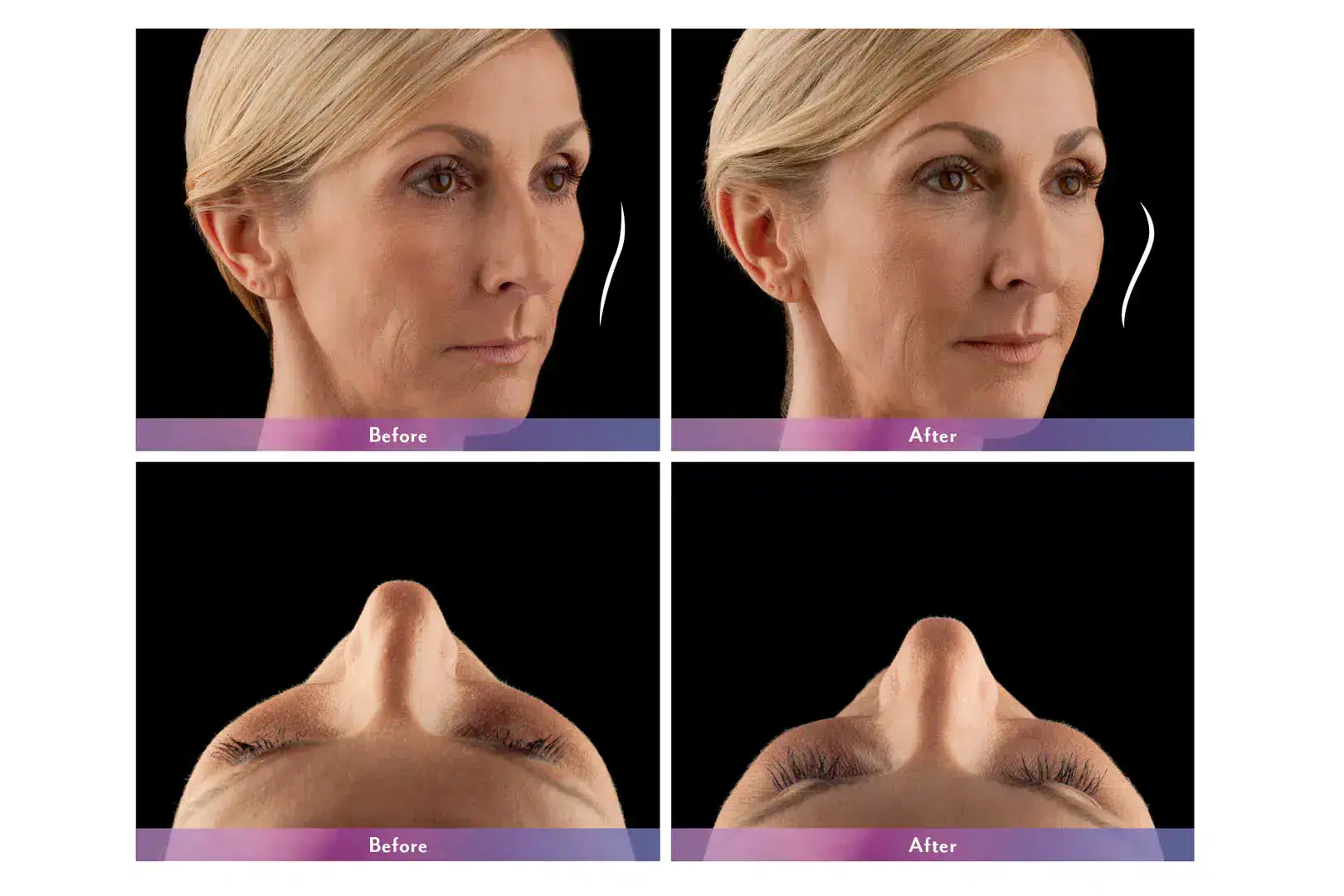 Womans's face before and after Juvederm treatment