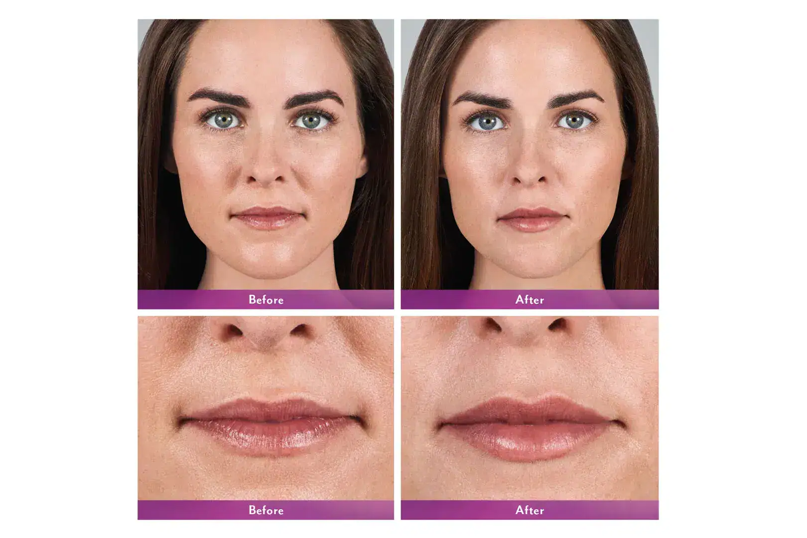 Womans's face before and after Juvederm treatment