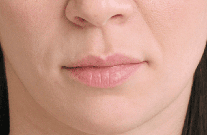 Womans face before treatment with Restylane Refyne
