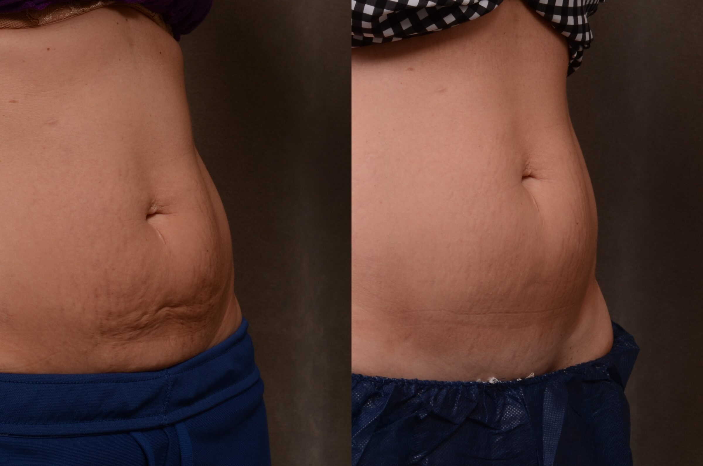 Pre Profound, and post single Profound Treatment of the abdomen