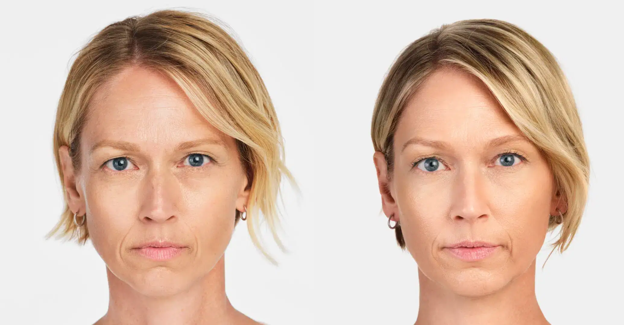 Womans face before and after Radiesse treatment