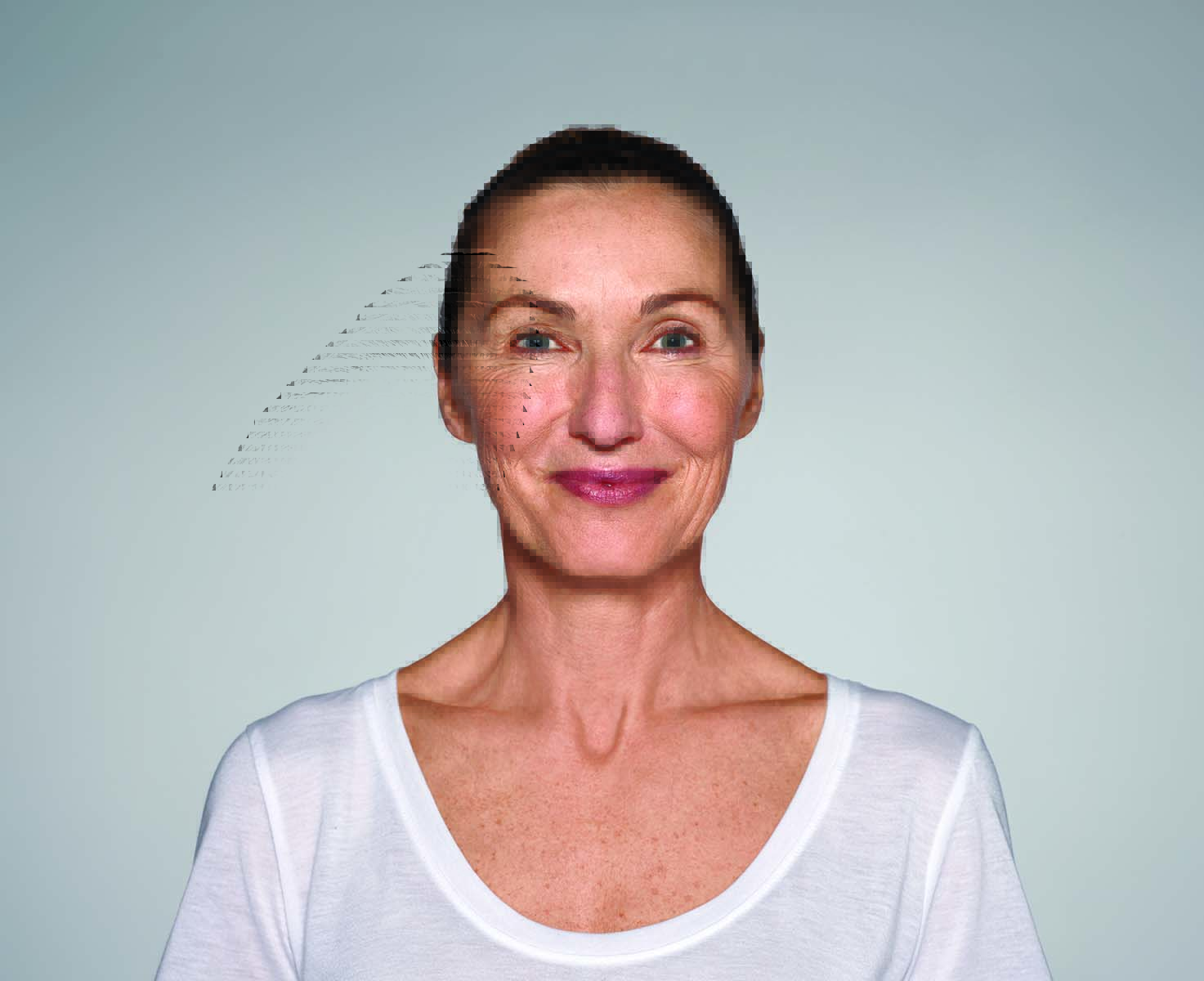 Womans face before treatment with Restylane Refyne