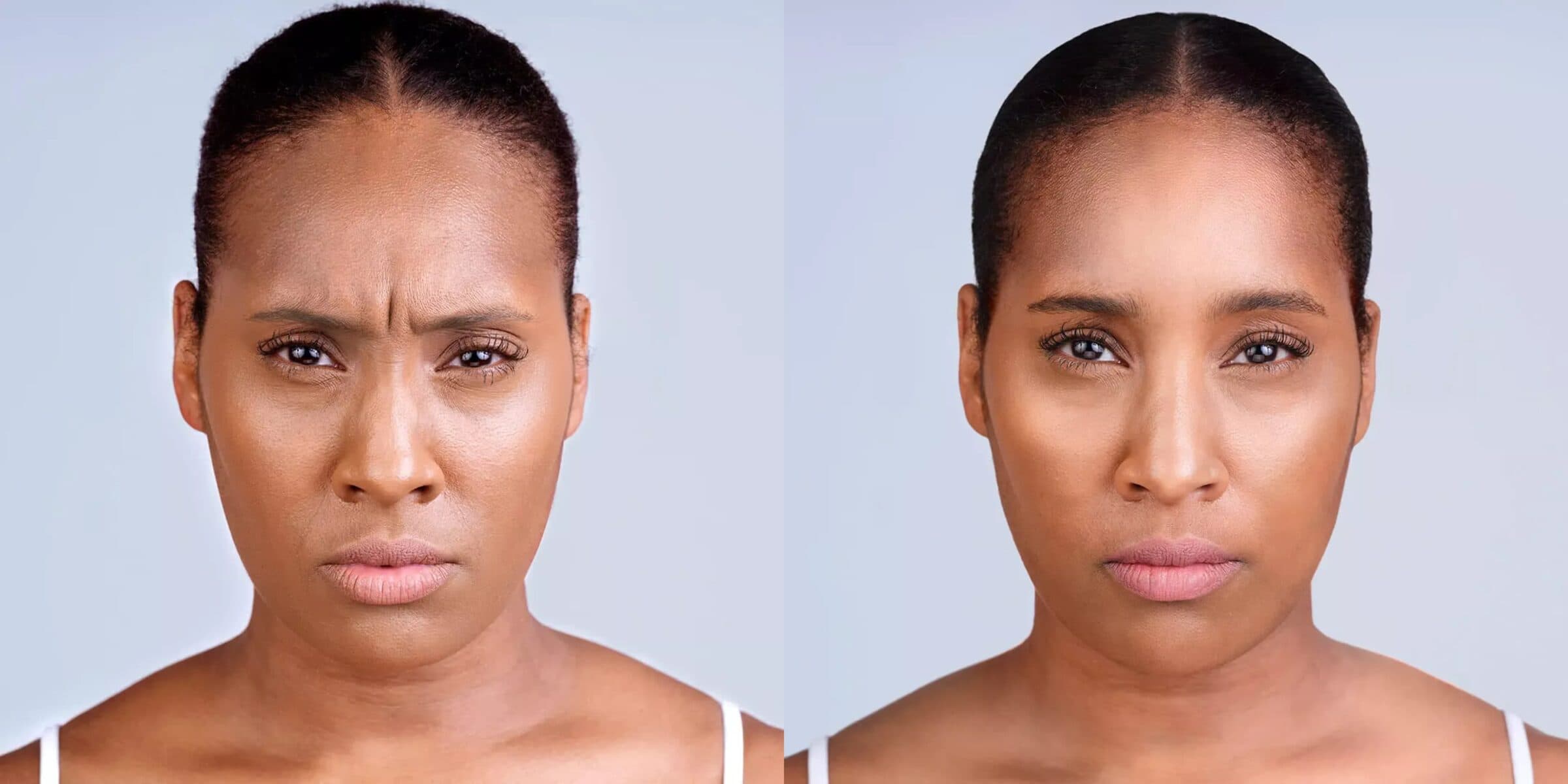 Womans face before and 30 days after Xeomin treatment
