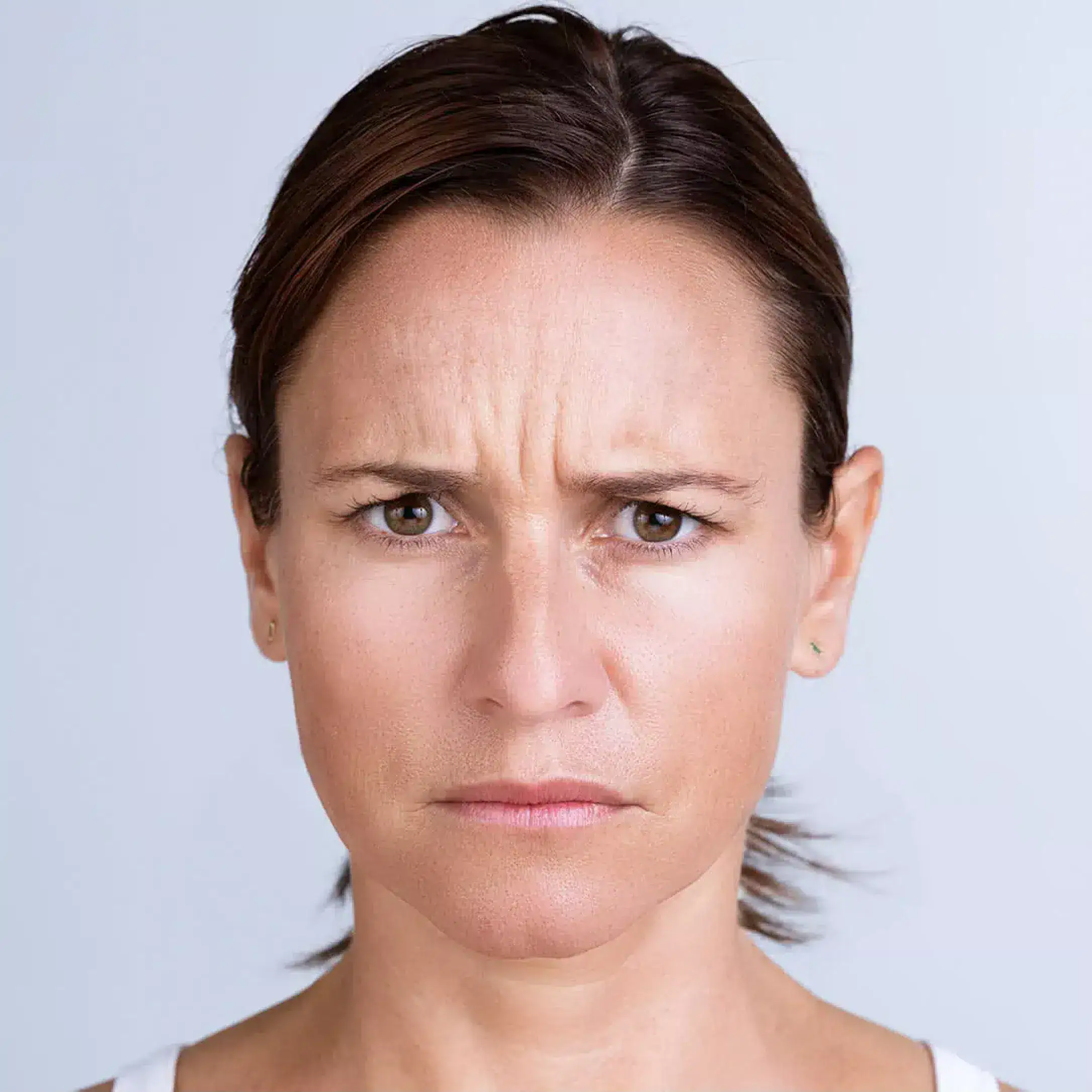 Womans face before Xeomin treatment