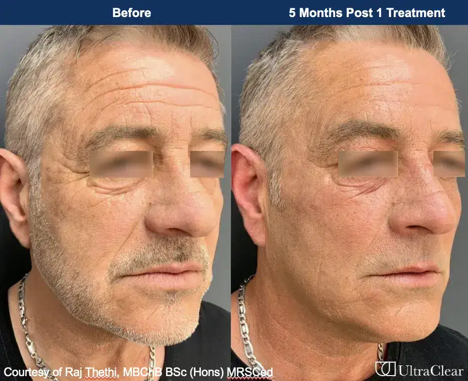 B&A 3