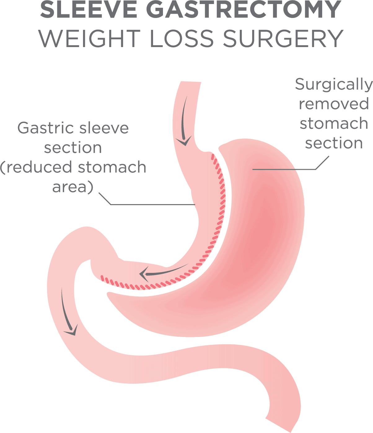 bariatric breakfast ideas