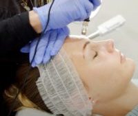 a woman receives a microneedling treatment for skin