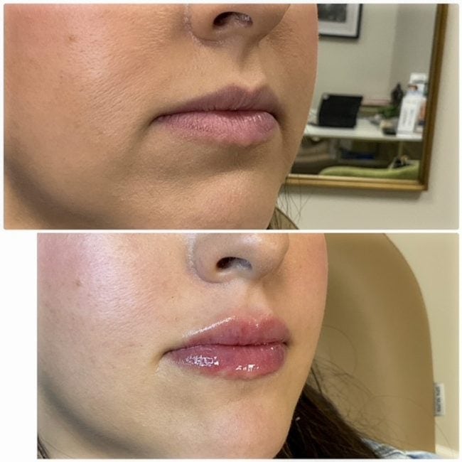 Lip and cheek enhancement before and after with dermal filler at Cloud Nine Aesthetics in Jacksonville IL.