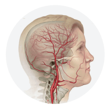 Carotid Artery Disease