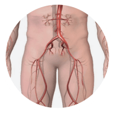 Peripheral Arterial Disease