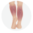Chronic Venous Insufficiency