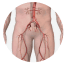 Peripheral Arterial Disease