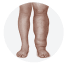 Swollen Leg