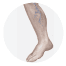 Varicose and Spider Veins
