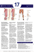 Above Knee Amputation