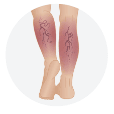 Chronic Venous Insufficiency