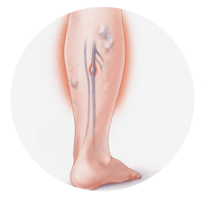 Deep Vein Thrombosis