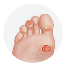 The Diabetic Foot