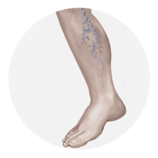 Varicose and Spider Veins