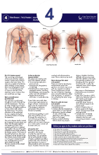 Aorto-Bifemoral or Aorto-Bi-iliac Graft