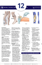 Sclerotherapy for Spider Veins