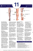 Varicose Vein Operation