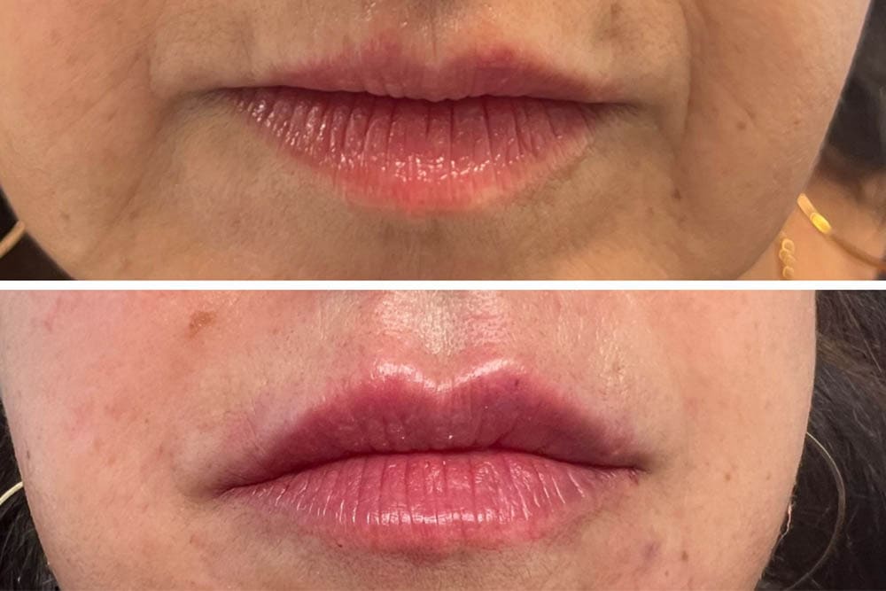 Aumento de labios en Clínica Fontana Valencia