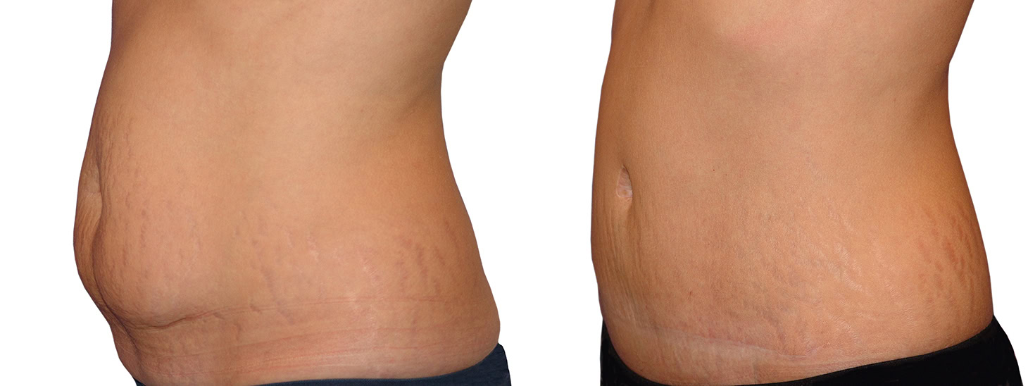 Lipectomía y abdominoplastia en Clínica Fontana Valencia