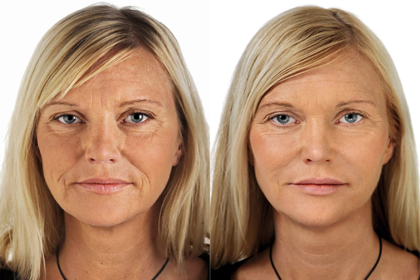 Mesoterapia facial en Clínica Fontana Valencia