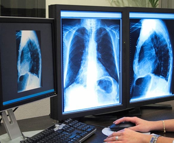 X-ray of lungs on a computer with three monitors