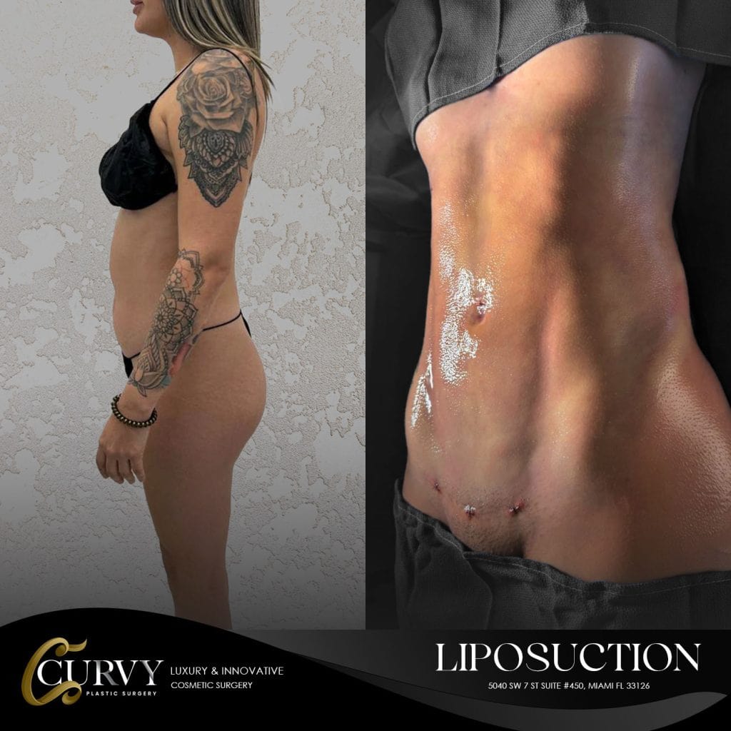 curvy_lipo (3)