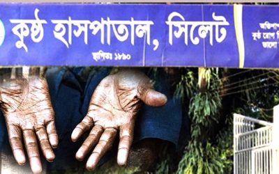 সিলেটে বেড়েছে কুষ্ঠ রোগের সংখ্যা, আক্রান্ত ৪২৬ জন