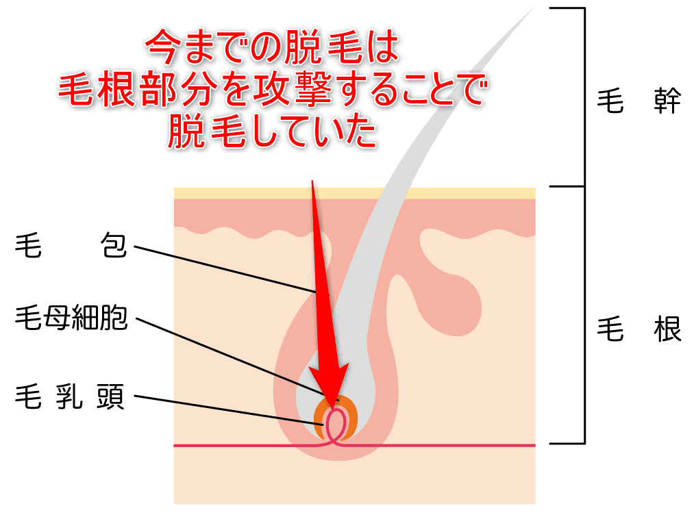 今までの脱毛は毛根部分を攻撃することで脱毛していたことを示した画像